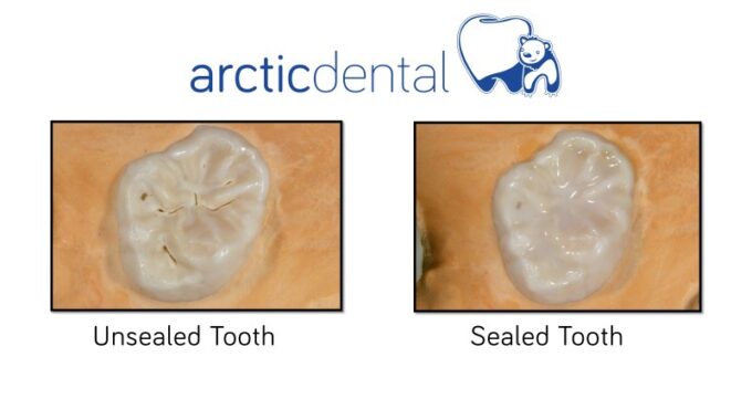 Dental Sealant in Muscatine