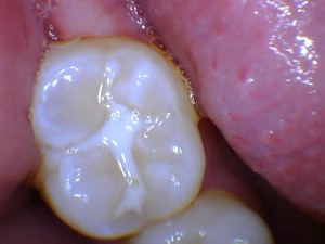 Sealant in the Mouth