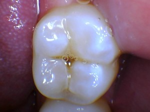 Cavity
