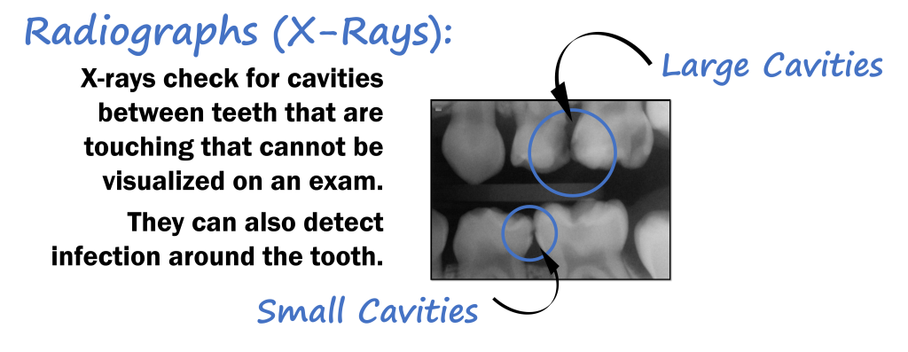 Bitewing X-Ray
