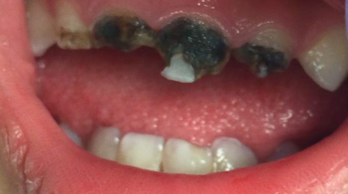 Silver Diamine Fluoride