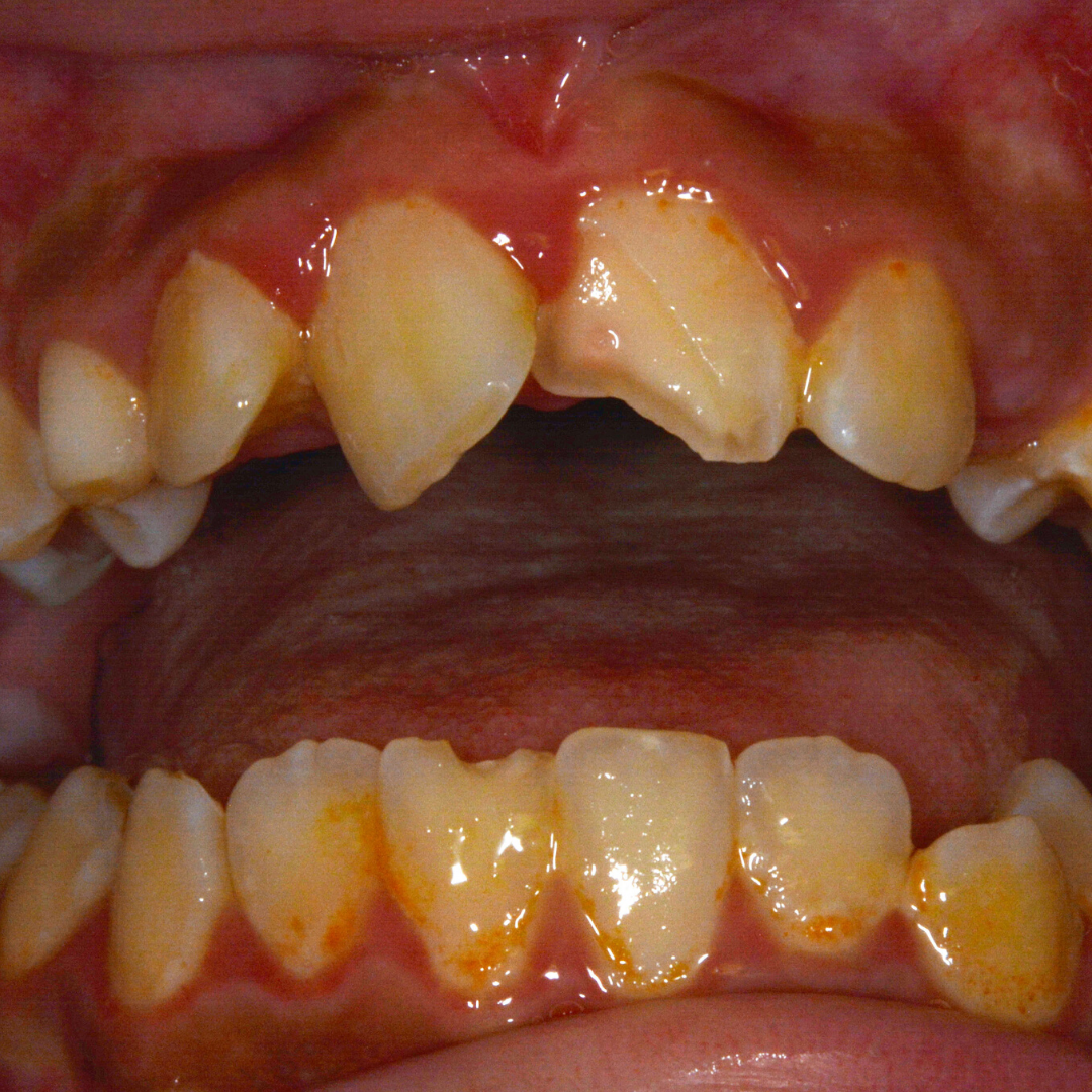Emergency Pediatric Dentistry in Muscatine