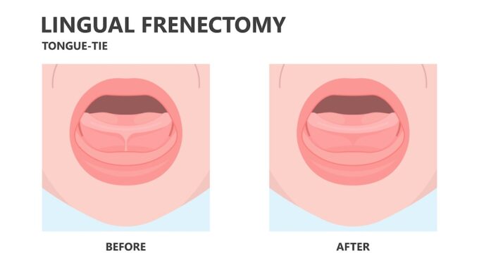 what is a lingual frenectomy?
