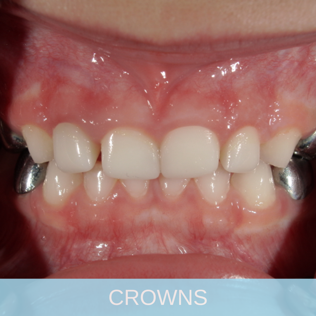 Crowns